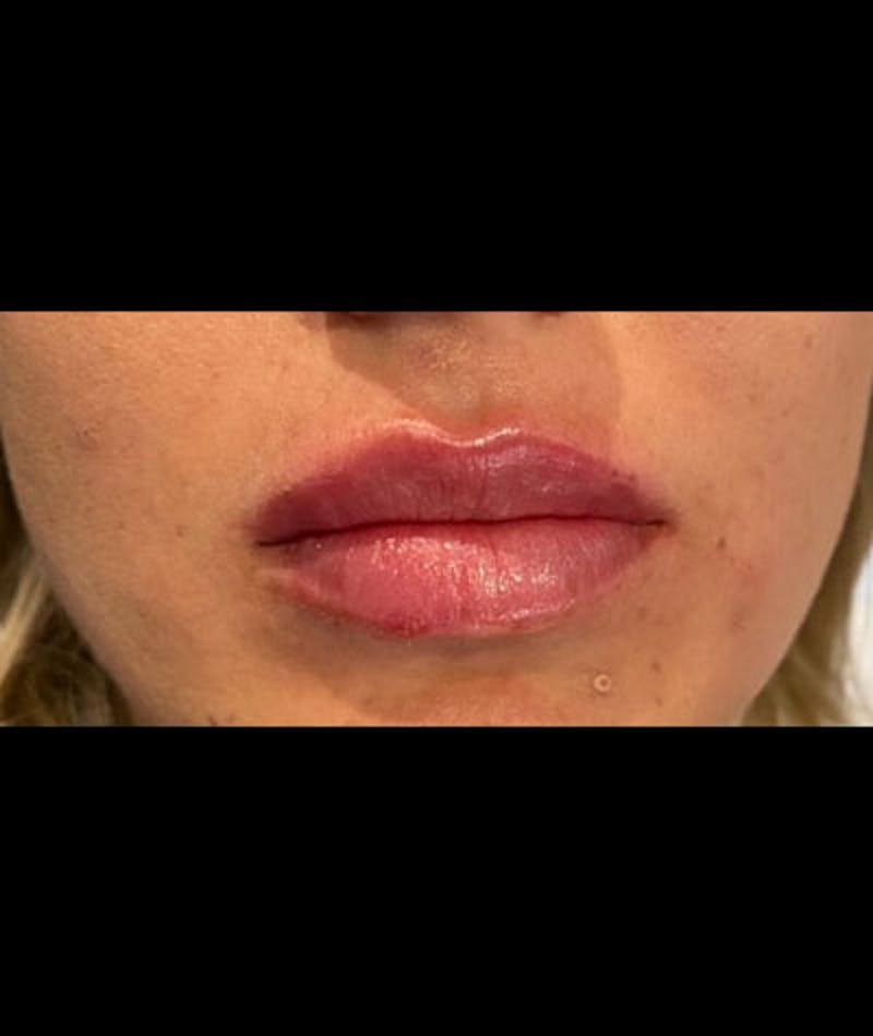 Fillers Before & After Gallery - Patient 109897636 - Image 2