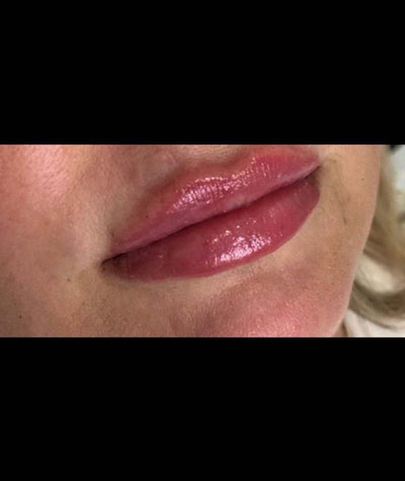 Fillers Before & After Gallery - Patient 109897639 - Image 2