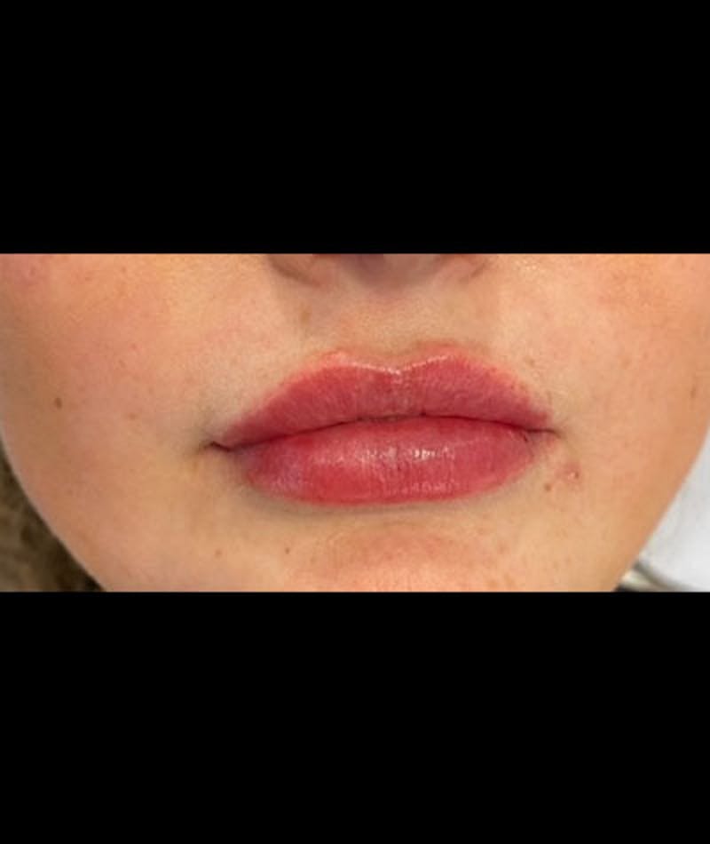 Fillers Gallery - Patient 109897640 - Image 2