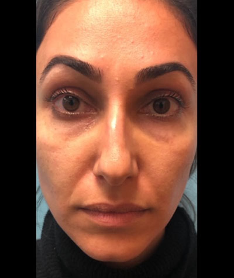 Fillers Before & After Gallery - Patient 109897643 - Image 1