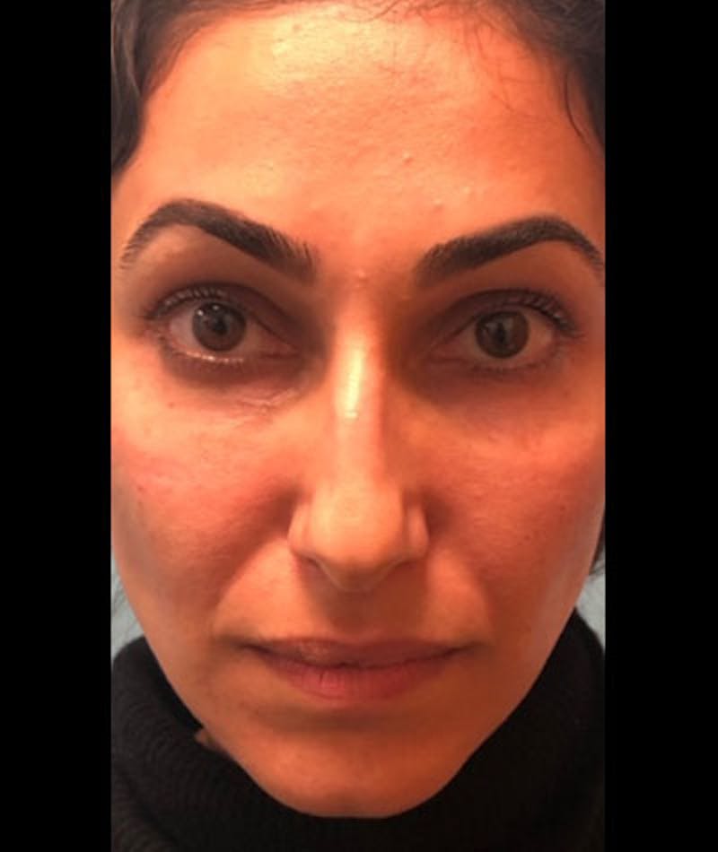 Fillers Before & After Gallery - Patient 109897643 - Image 2