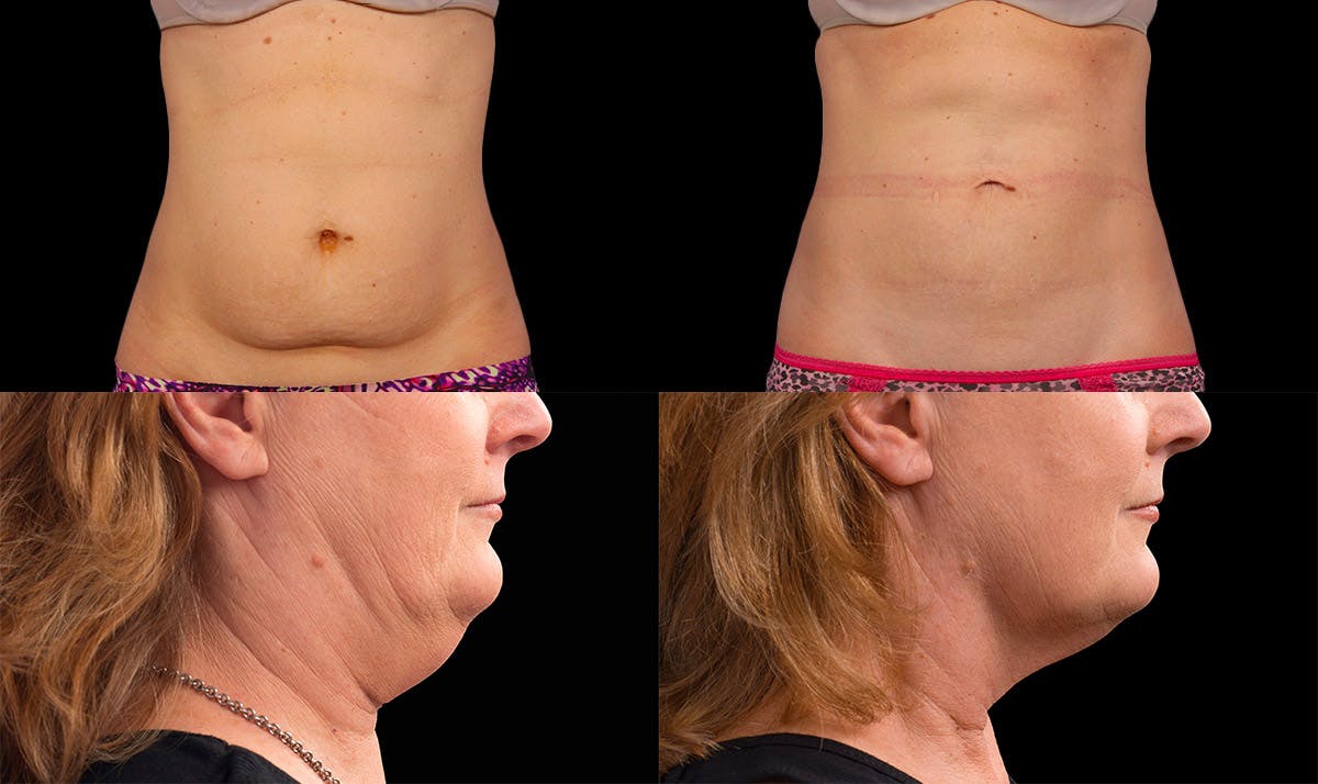 Body fat removal before and after