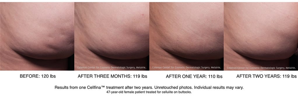 Before and after Cellfina treatment in Beverly Hills