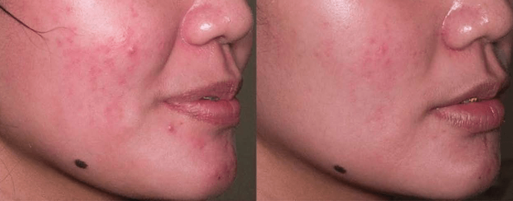 proyelow laser before and after 1