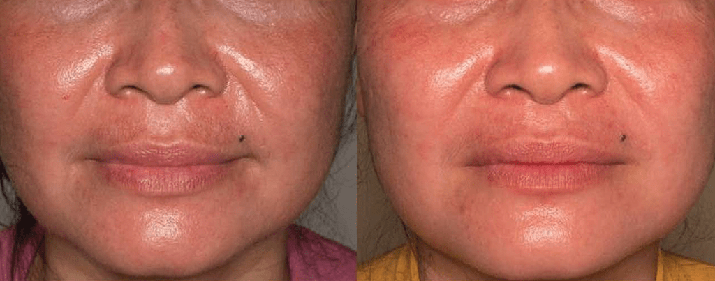 proyelow laser before and after 2