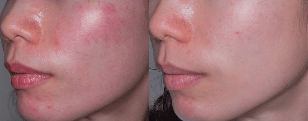 proyelow laser before and after 3