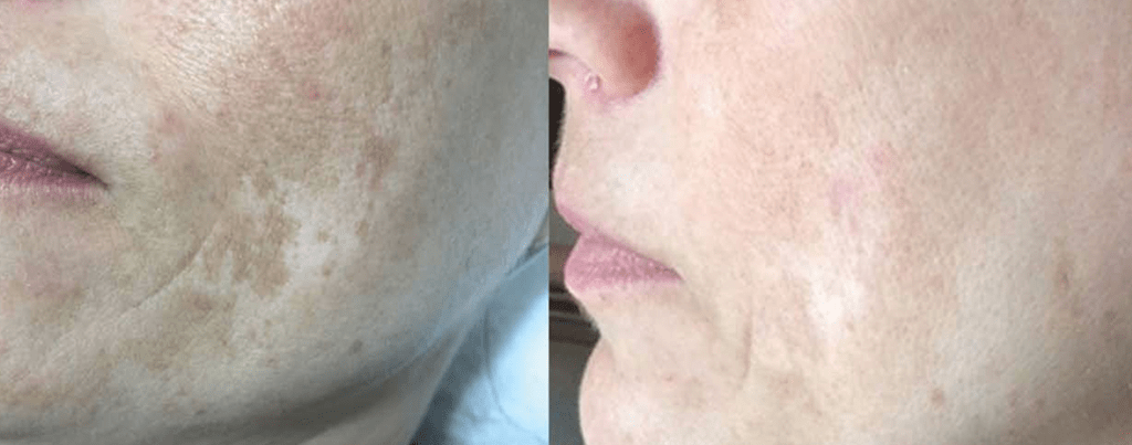 proyelow laser before and after 4