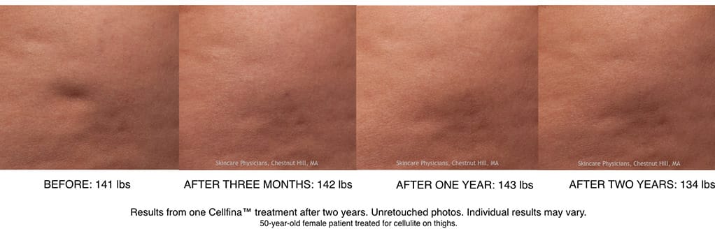Before and after cellulite reduction in Beverly Hills