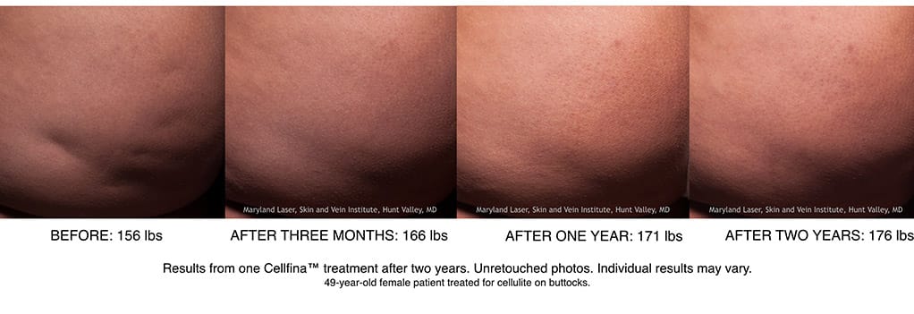 Before and after Cellfina cellulite reduction in Los Angeles