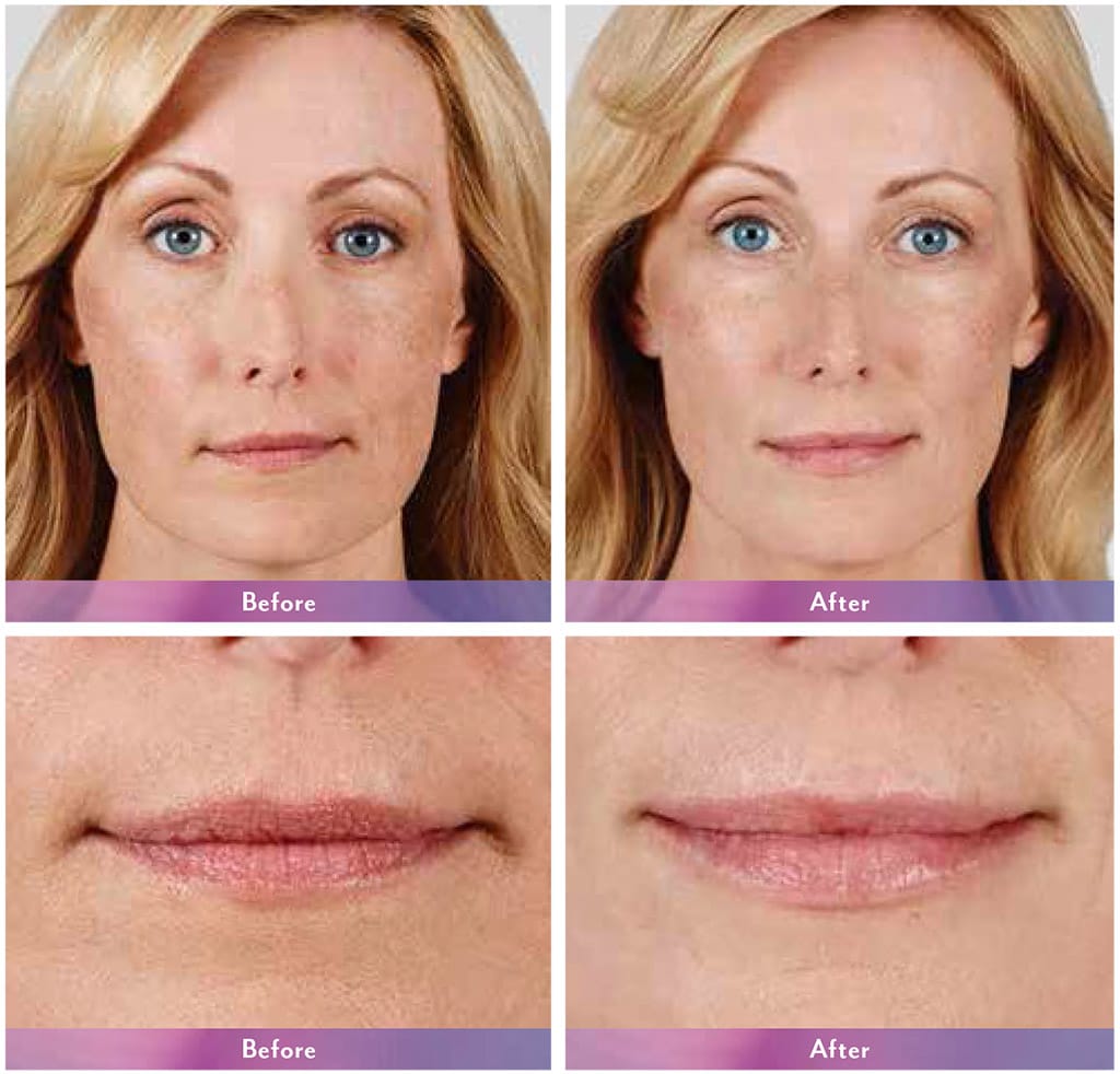 Juvéderm Ultra Plus XC before and after