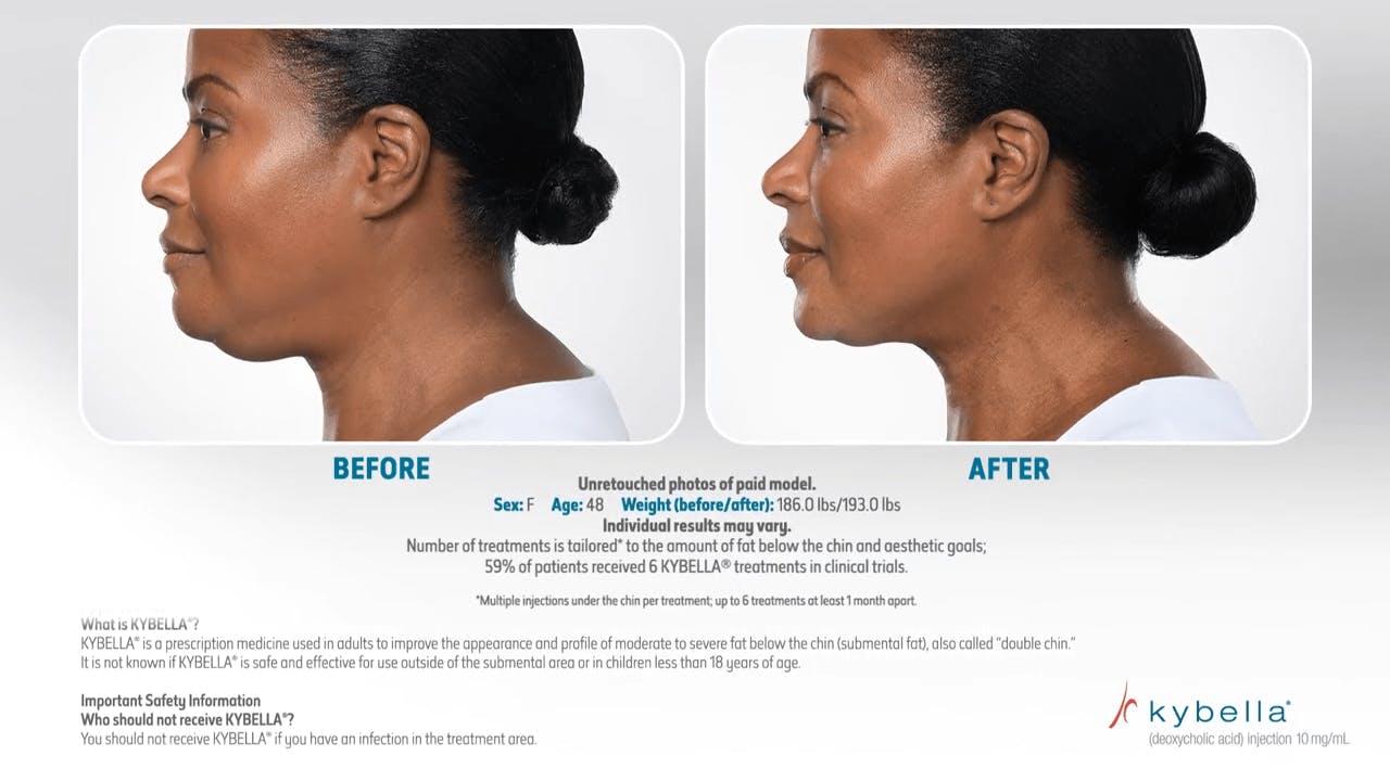 kybella video