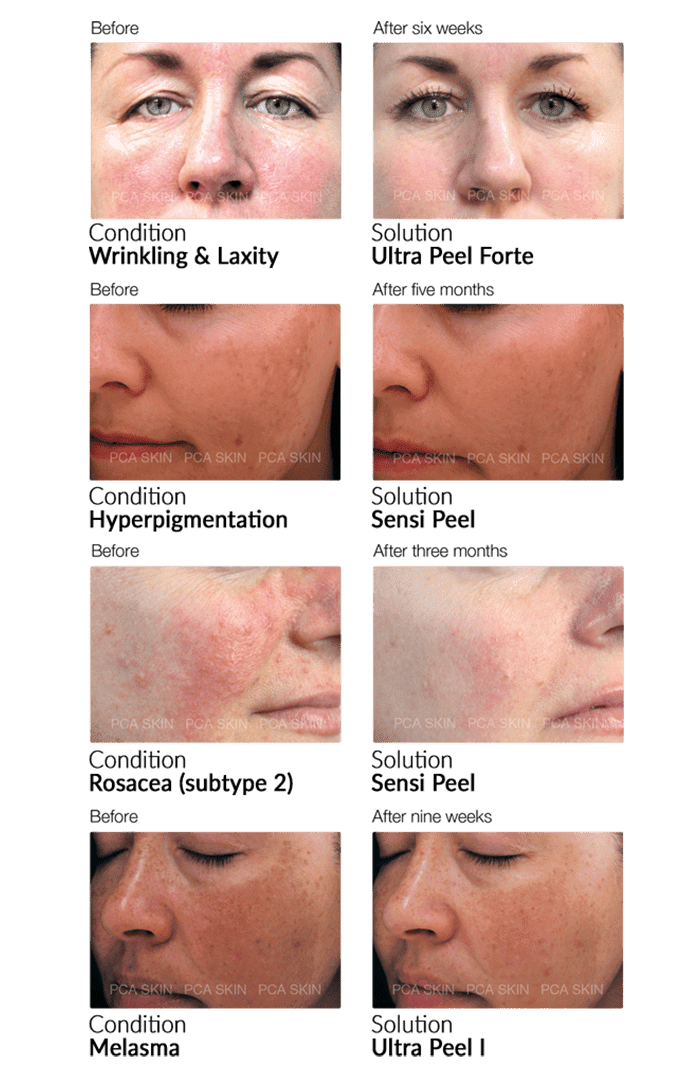 PCA chemical peel results