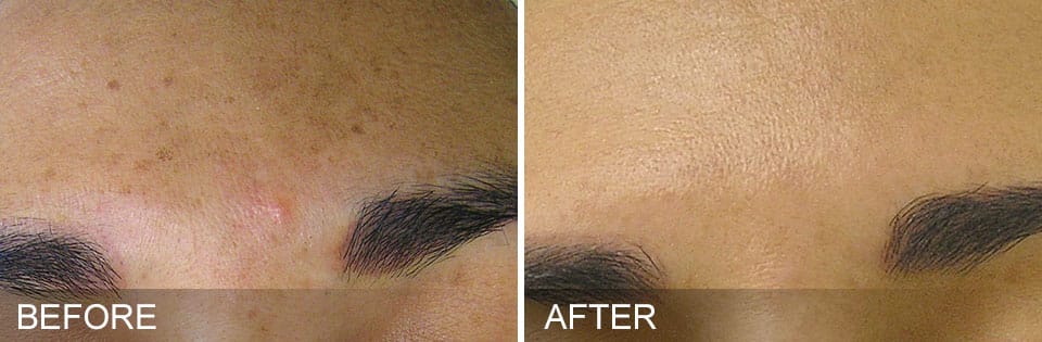 HydraFacial Before and After