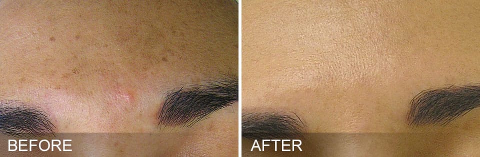 HydraFacial Before and After Photo