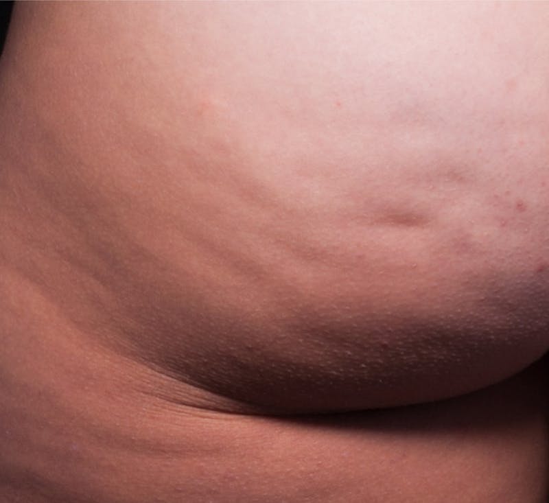 Cellfina Before & After Gallery - Patient 113764492 - Image 1