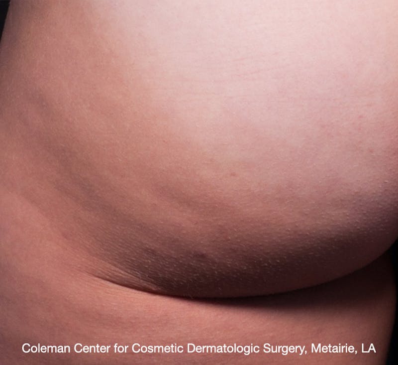 Cellfina Before & After Gallery - Patient 113764492 - Image 2