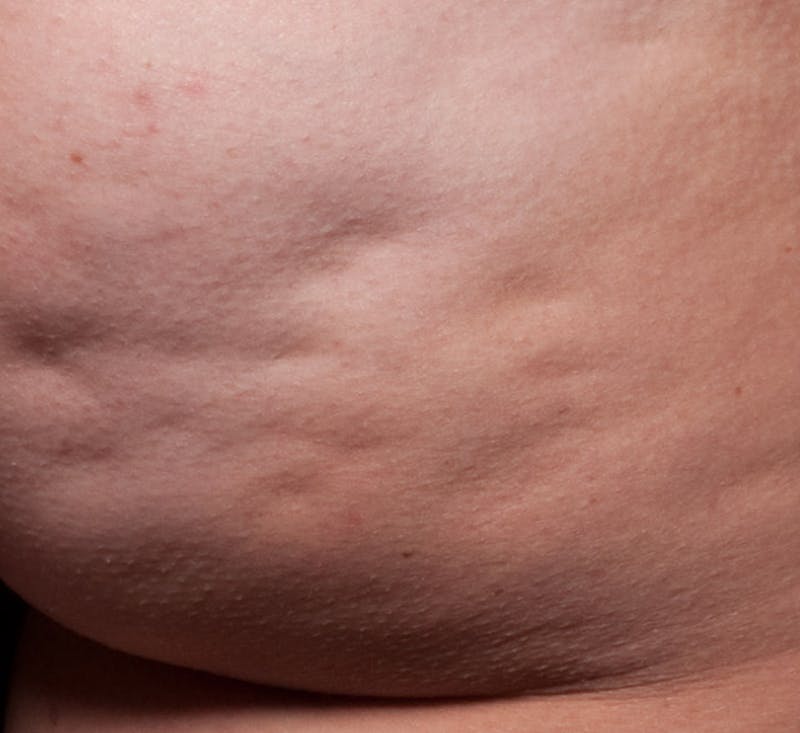 Cellfina Before & After Gallery - Patient 113764493 - Image 1