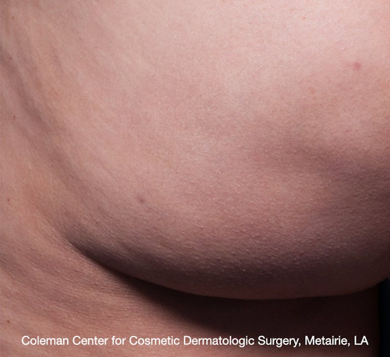 Cellfina Before & After Gallery - Patient 113764494 - Image 2