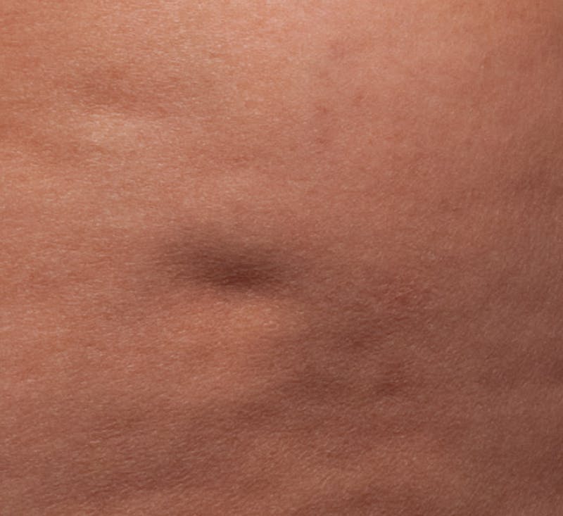 Cellfina Before & After Gallery - Patient 113764495 - Image 1