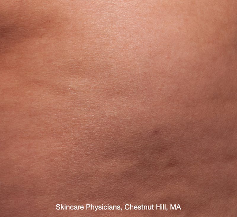 Cellfina Before & After Gallery - Patient 113764495 - Image 2