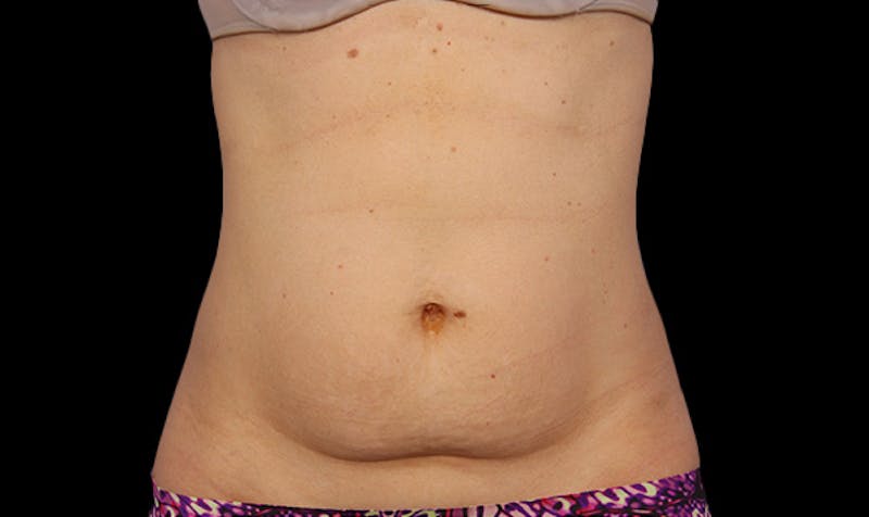 CoolSculpting Before & After Gallery - Patient 113764616 - Image 1