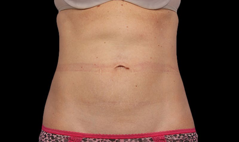 CoolSculpting Before & After Gallery - Patient 113764616 - Image 2