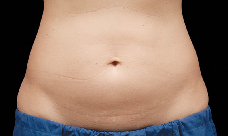 CoolSculpting Before & After Gallery - Patient 113764617 - Image 1