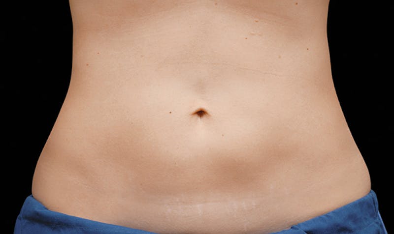 CoolSculpting Before & After Gallery - Patient 113764617 - Image 2