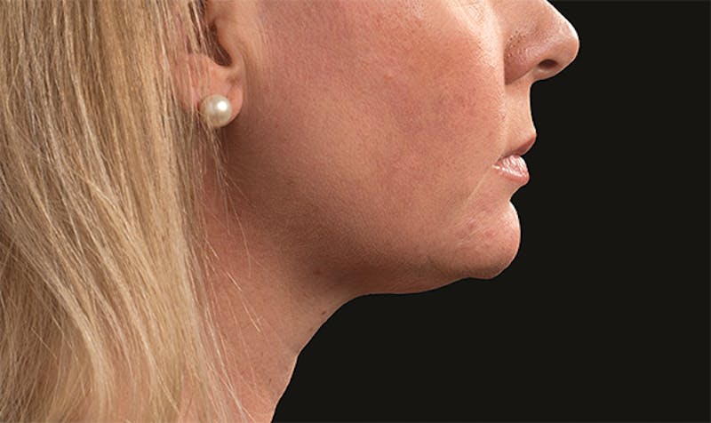 CoolSculpting Before & After Gallery - Patient 113764618 - Image 2