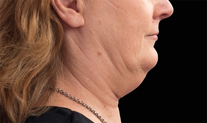 CoolSculpting Before & After Gallery - Patient 113764639 - Image 1