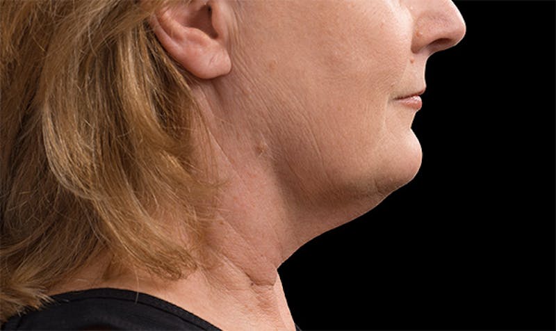 CoolSculpting Before & After Gallery - Patient 113764639 - Image 2