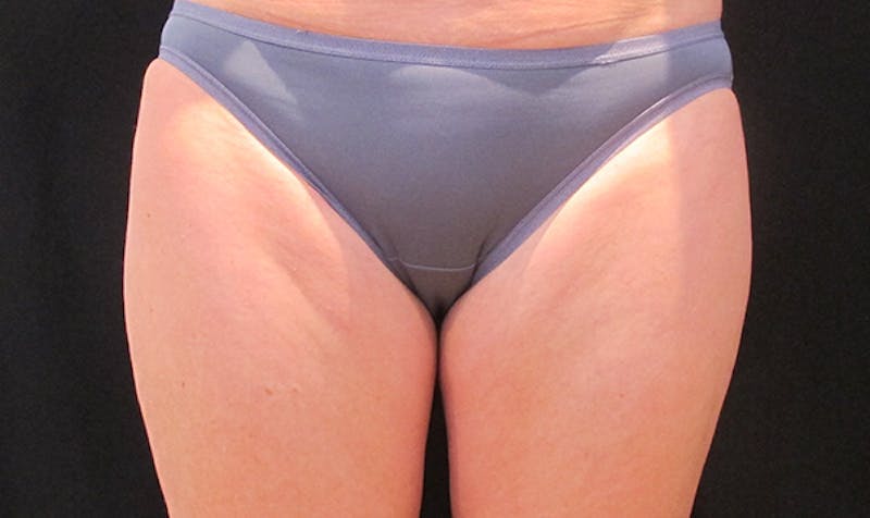 CoolSculpting Before & After Gallery - Patient 113764619 - Image 1