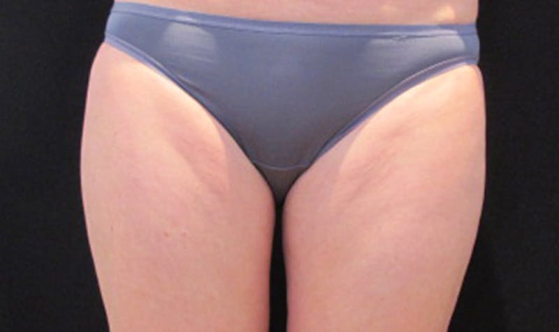 CoolSculpting Before & After Gallery - Patient 113764619 - Image 2