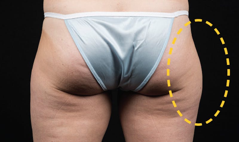 CoolSculpting Before & After Gallery - Patient 113764620 - Image 1