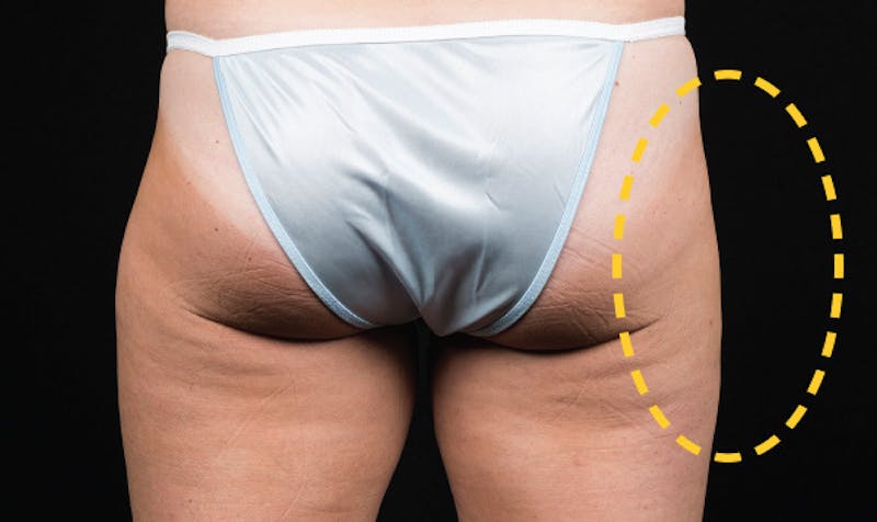 CoolSculpting Before & After Gallery - Patient 113764620 - Image 2