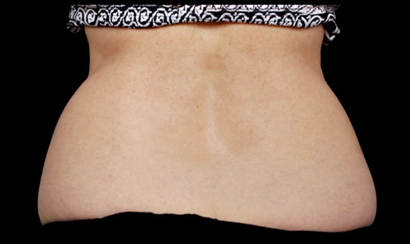 CoolSculpting Before & After Gallery - Patient 113764621 - Image 1