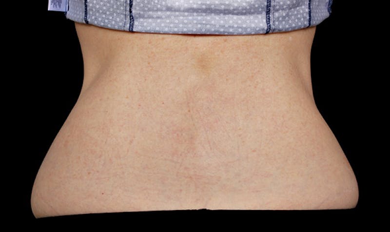 CoolSculpting Gallery - Patient 113764621 - Image 2