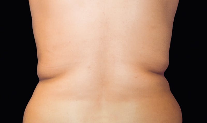 CoolSculpting Before & After Gallery - Patient 113764622 - Image 1