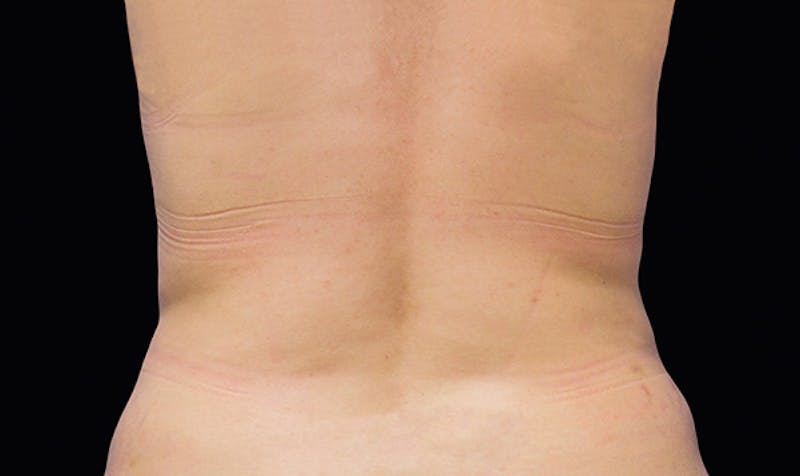 CoolSculpting Before & After Gallery - Patient 113764622 - Image 2
