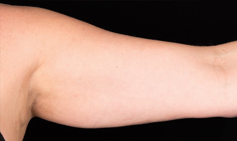 CoolSculpting Before & After Gallery - Patient 113764623 - Image 1