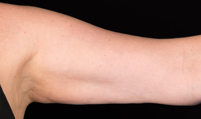 CoolSculpting Before & After Gallery - Patient 113764623 - Image 2