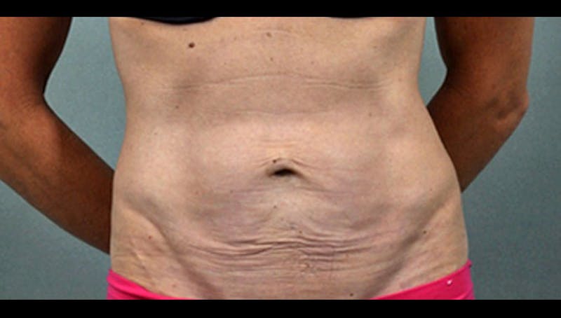 Thermismooth Before & After Gallery - Patient 113764792 - Image 1
