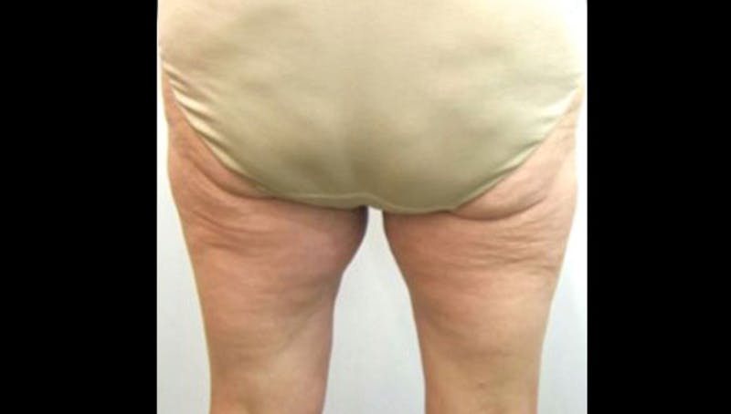 Thermismooth Before & After Gallery - Patient 113764793 - Image 1