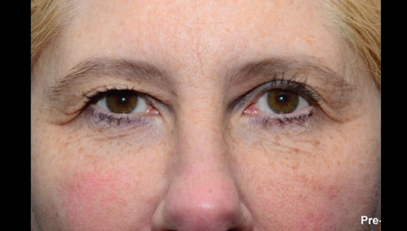 Thermismooth Before & After Gallery - Patient 113764794 - Image 1