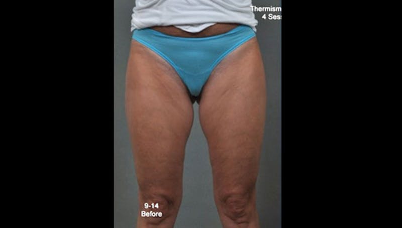 Thermismooth Before & After Gallery - Patient 113764791 - Image 1