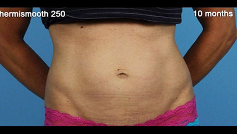 Thermismooth Before & After Gallery - Patient 113764792 - Image 2