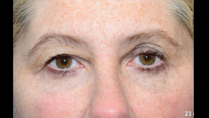 Thermismooth Before & After Gallery - Patient 113764794 - Image 2
