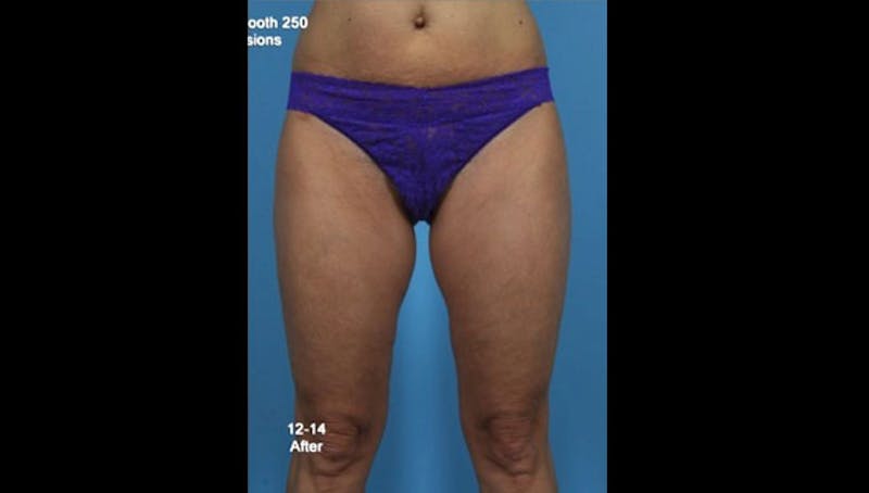 Thermismooth Before & After Gallery - Patient 113764791 - Image 2