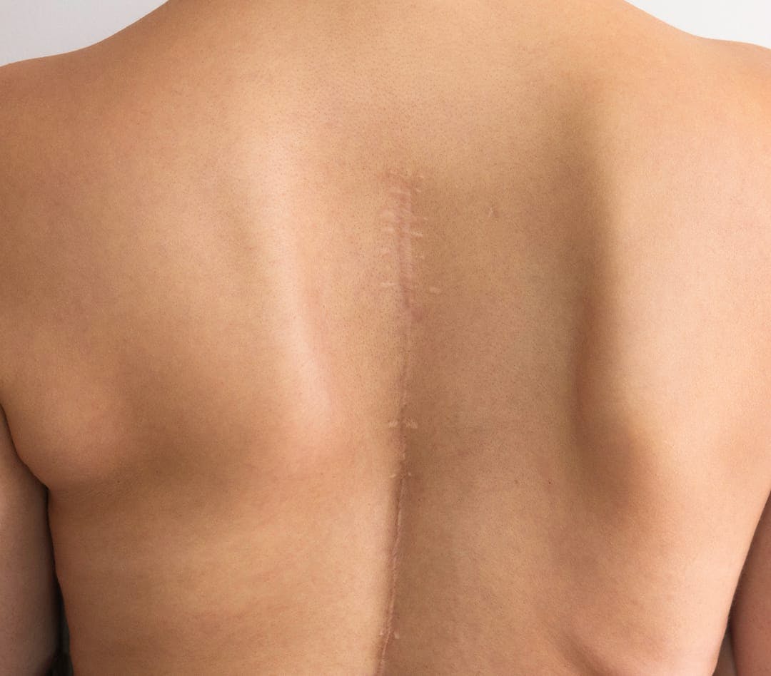 Scar down center of back