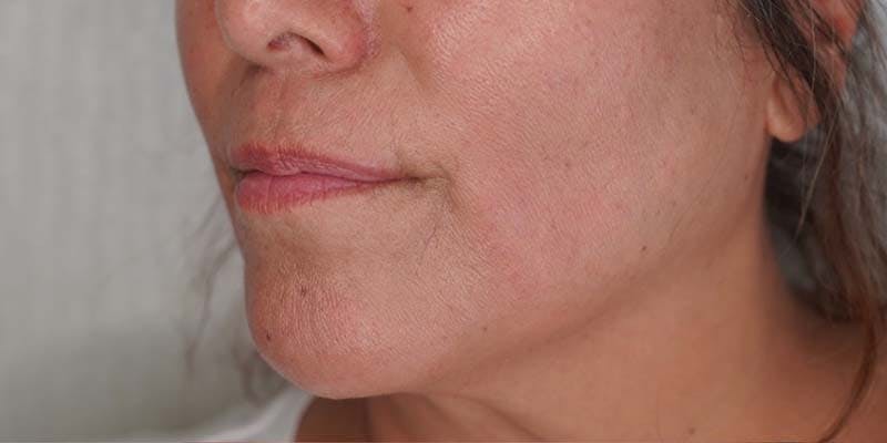 Fillers Before & After Gallery - Patient 121378555 - Image 1